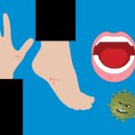 子供が感染に注意すべき、発疹性ウイルス4選！