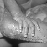 欧米でサル痘ウイルスの感染者が相次いで確認される!