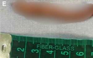 【衝撃】メキシコで尻尾が生えた女児が誕生していた!?