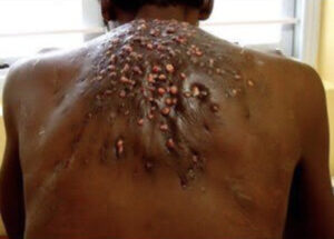 人間に寄生する激ヤバ寄生虫12選!知らないうちに寄生されているかも...